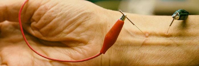 Evolución de la acupuntura y dolor