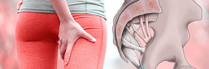 ¿Neuralgia o neuropatía del pudendo?