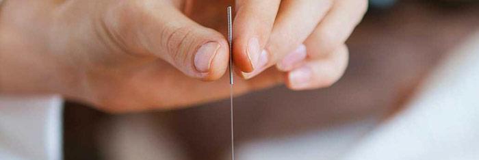 Acupuntura para adelgazar