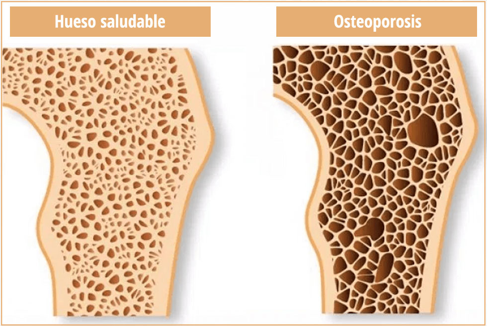 Osteoporosis vs. hueso saludable