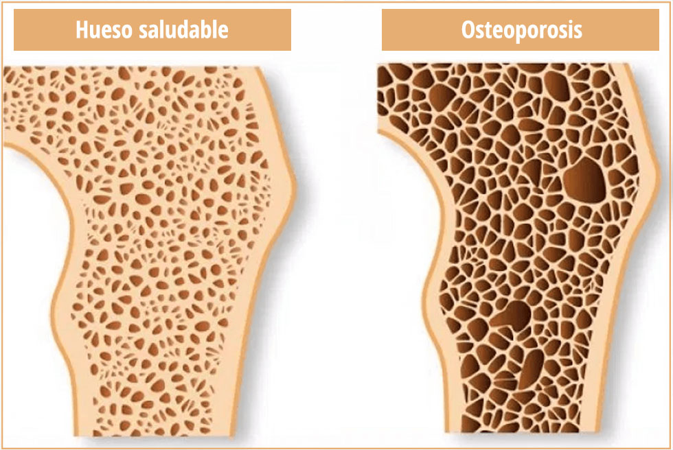 Osteoporosis vs. hueso saludable