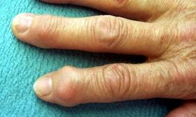 Artrosis en las manos