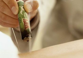 La moxibustion