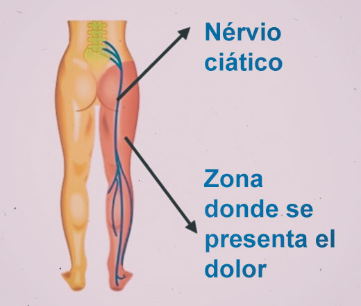 Dolor provocado por el nervio ciático