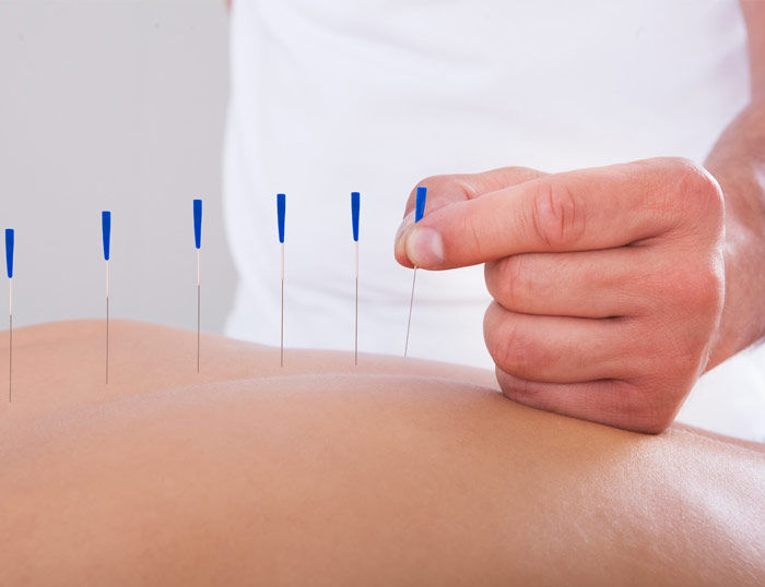 Tratamiento de lesiones medulares con acupuntura