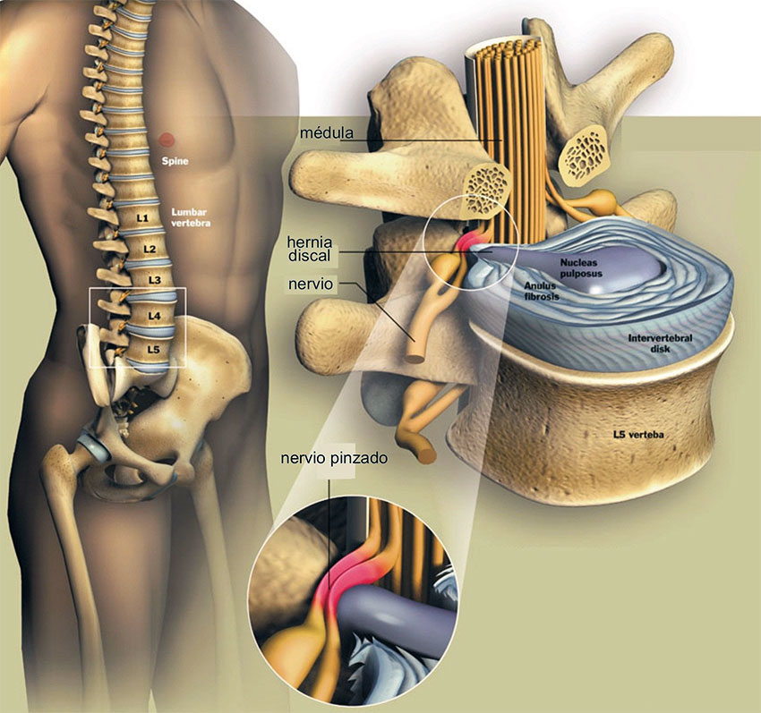 Esquema de una hernia discal