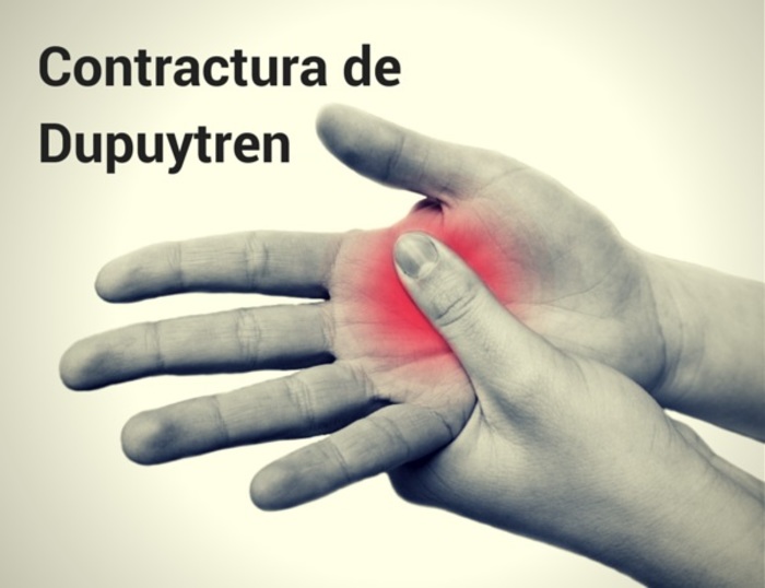 Contractura de Dupuytren