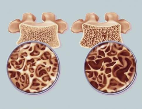 Osteoporosis: problemas con el riñón en Medicina tradicional china