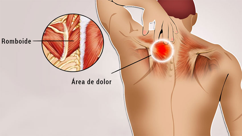 Zona del dolor romboides derecho