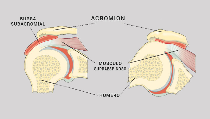 Esquema del hombro - acromion
