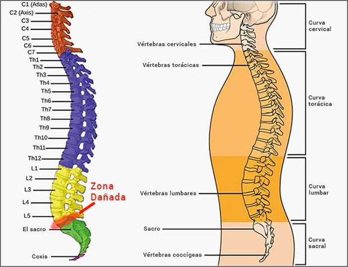 Hernia discal DCH L5-S1 y disfunción de útero