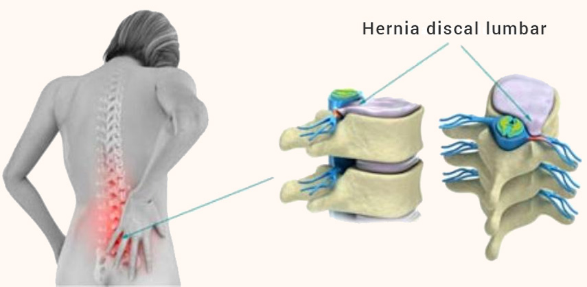 Localización de la hernia discal lumbar