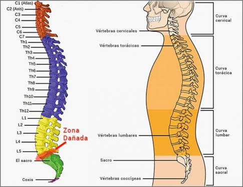 Hernia discal DCH L5-S1 y disfunción de útero