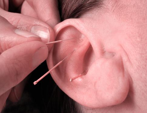 Qué es la auriculoterapia