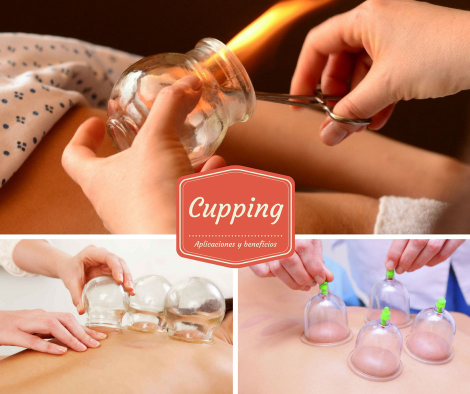 Cupping, aplicación y beneficios de la terapia con ventosas