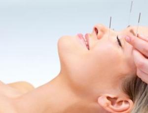 Lifting facial con acupuntura