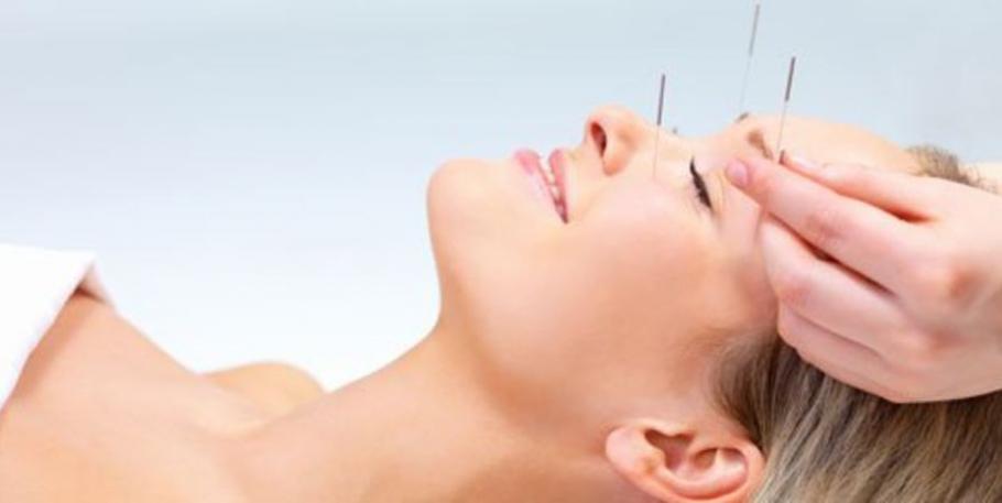 Lifting facial con acupuntura