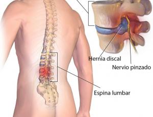 Técnica de absorción específica de la hernia lumbar discal