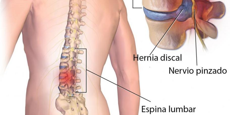 Técnica de absorción específica de la hernia lumbar discal